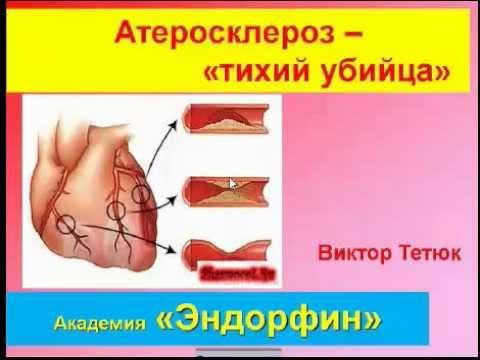 ***Как избавиться от атеросклероза? Эндорфинотерапия.